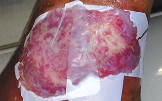 apply dressing to wound