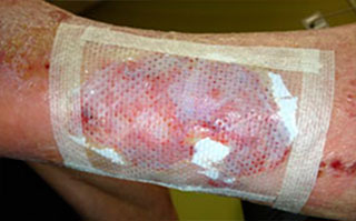 fixate with suture strips