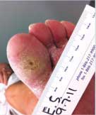 diabetic foot ulcer before