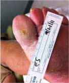 diabetic foot ulcer after