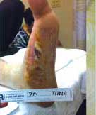 diabetic foot ulcer treatment