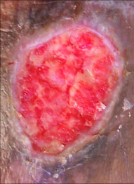 venous leg ulcer