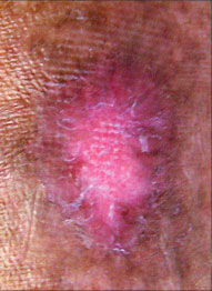 healed venous leg ulcer after treatment